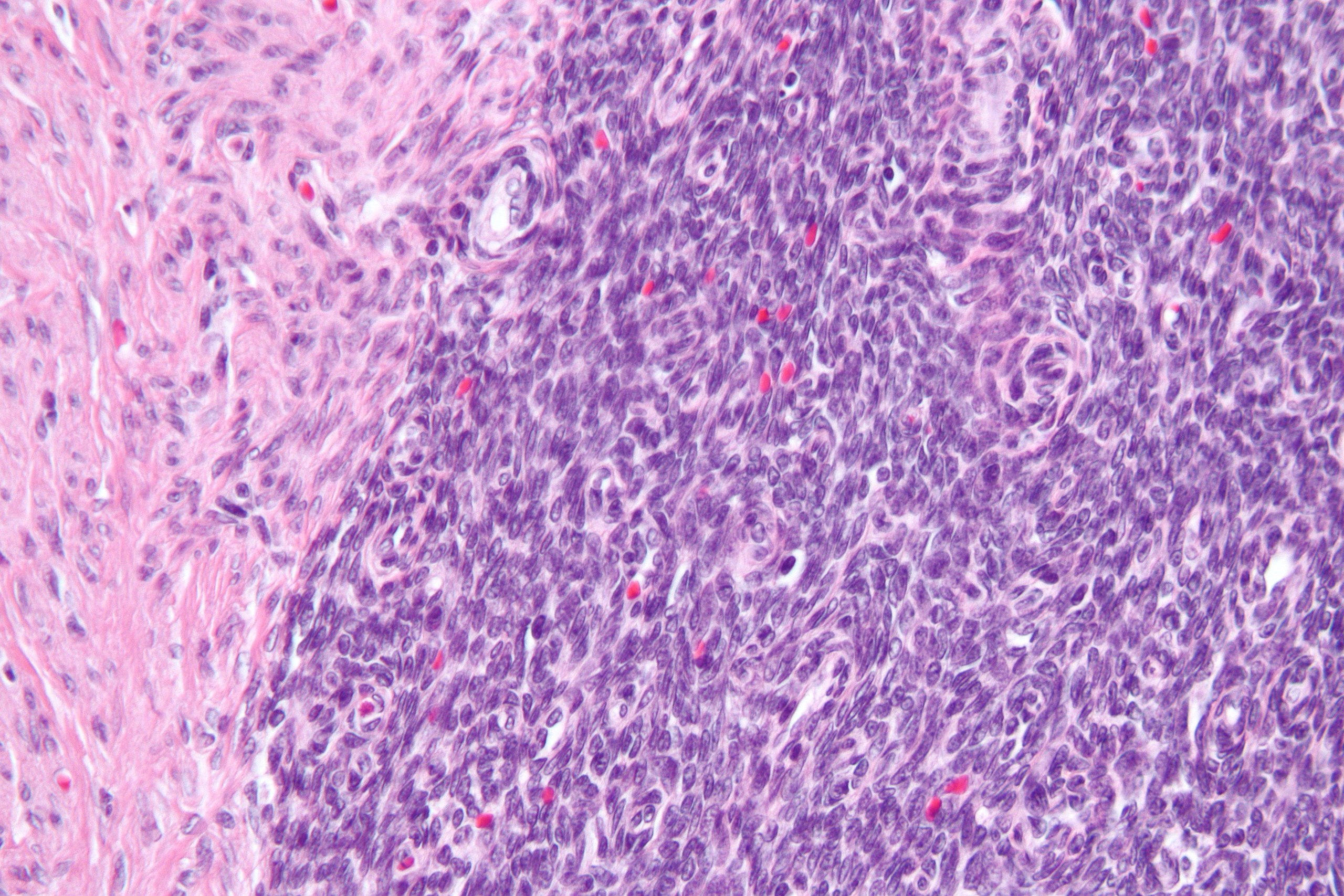 Endometriales Stromasarkom